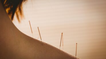 young-woman-getting-acupuncture-treatment-in-therapy-room